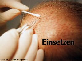 Haartransplantationen Einsetzen Haartransplantationen Einsetzen