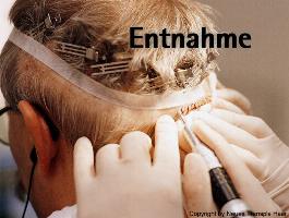 Haartransplantationen Entnahme