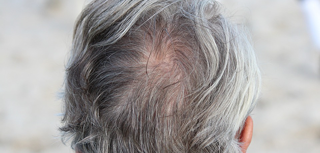 Haarausfall | Friseur.com