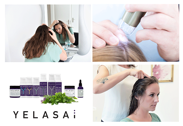 Fachwissen Reloaded Die 5 Haufigsten Formen Des Haarausfalls Gianni Coria Klart Auf Friseur Com